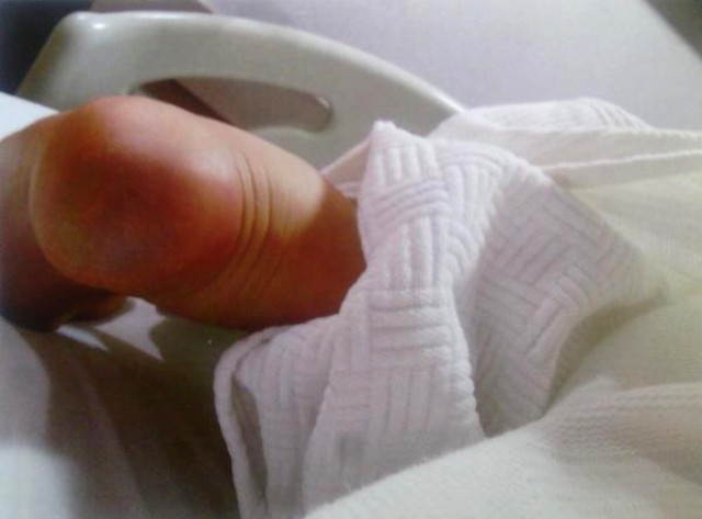 Doğumdan Çıkan Annenin Ayaklarını Yakan Hemşireler İçin Karar Verildi