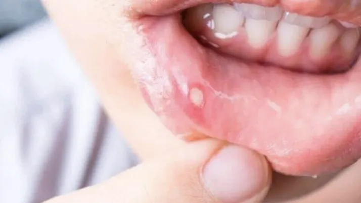 Aft nasıl geçer evde ağız yarası aft tedavisi nasıl yapılır?