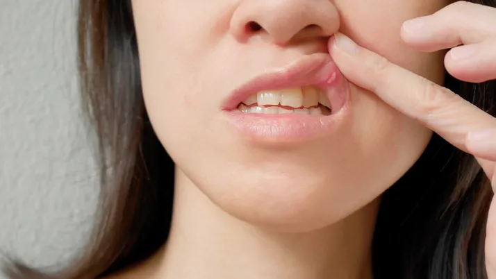 Aft nasıl geçer tuz karbonat sumak ile ağız yarası aft tedavisi nasıl?