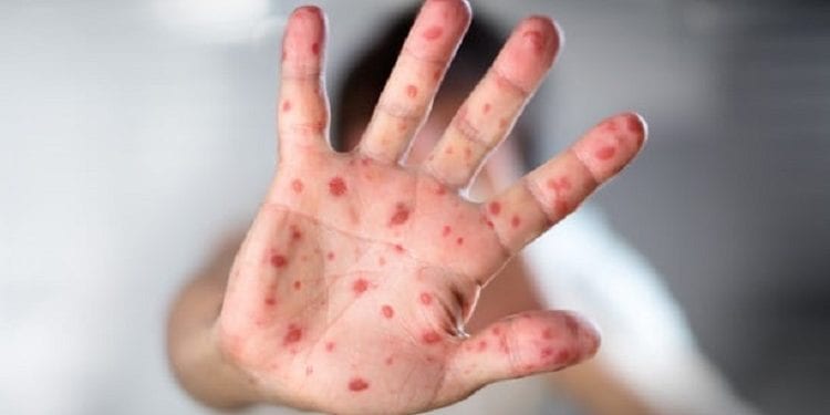 Son Dakika Dünya Sağlık Örgütü’nden kızamık ve menenjit atağı