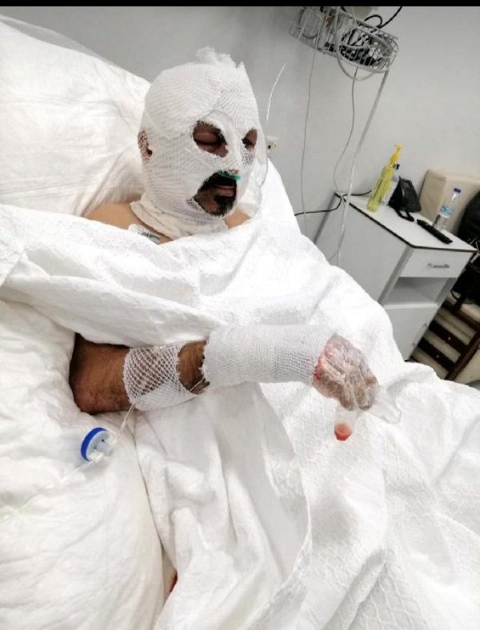 Öğrenci servisi şoförünün üzerine tiner döküp yaktı